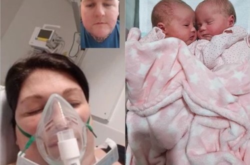 Koronavirusa görə komaya düşən hamilə qadın əkiz uşaqlar dünyaya gətirdi - FOTO