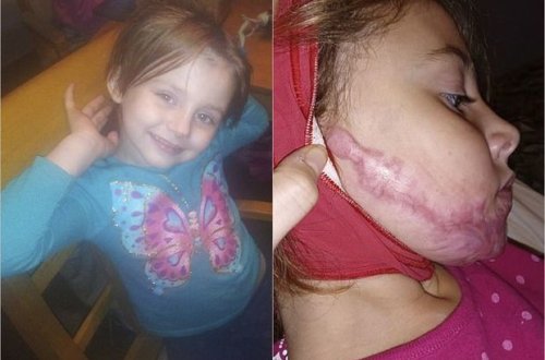 Шестилетняя девочка играла с антисептиком и получила ожоги лица - ФОТО