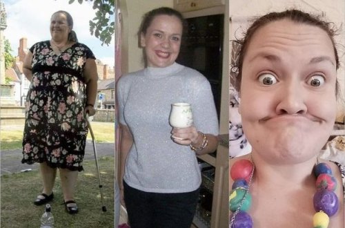 Arıqlama əməliyyatı elətdirən qadın bütün dişlərini itirib - FOTO