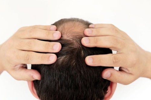 Həkim COVID-19-un saç tökülməsinə təsirlərindən danışıb