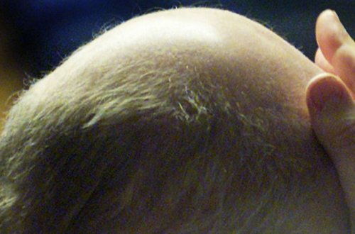 Врач раскрыл причины облысения при COVID-19