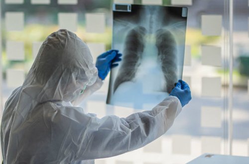 Azərbaycanda daha 34 nəfər koronavirusdan öldü: 1052 yeni yoluxma - FOTO