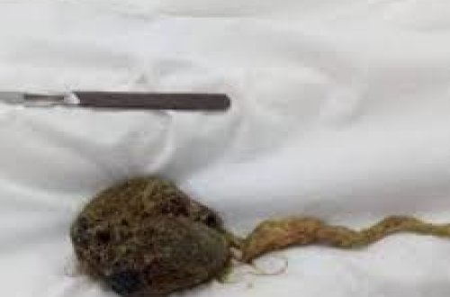 Из желудка россиянки удалили 300-граммовый ком волос