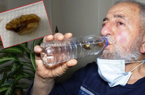 Koronavirusundan şübhələndilər, ağciyərdən qoz çıxdı - FOTO