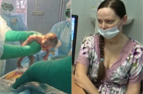 Koronavirusa görə ağciyərləri 100 faiz zədələnən hamilə qadın xilas edildi - VİDEO