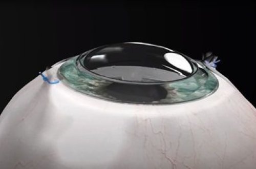 Görməni bərpa edən süni implant yaradıldı