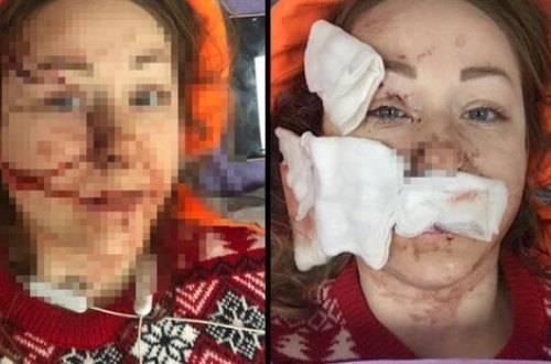 Boşanmaq istəyən arvadının ÜZÜNÜ DOĞRADI