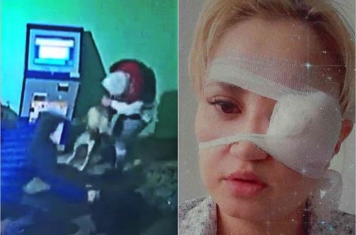 İtin dişlədiyi qadın gözünü itirmək təhlükəsi ilə üzləşdi - ANBAAN VİDEO