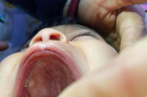 Bakıda uşağın ağzından çıxan yad cisim təəccübləndirdi - 2 aydır bu vəziyyətdə... - FOTO