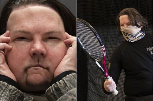 Yaşamaq üçün yeni şans: Üz və əl transplantasiyası olan şəxs həyatı yenidən öyrənir - FOTO/VİDEO