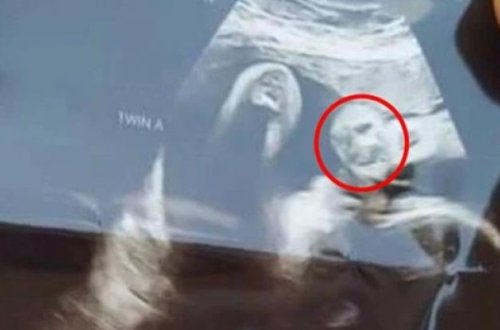 Hamilə qadın ultrasəs müayinəsi zamanı böyük şok yaşadı - FOTOLAR