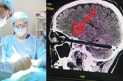 Qələmi beynindən çıxarıb pasiyentə hədiyyə etdilər – FOTO