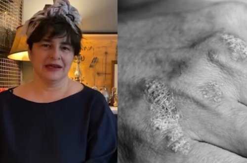 Məşhur aktrisa bu xəstəlikdən əziyyət çəkir - FOTO