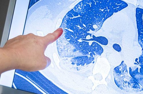 Koronavirus hansı halda ağciyərdə fəsad saxlayır?