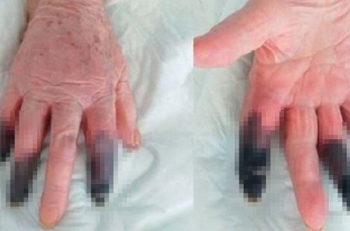 Koronavirus səbəbindən qanqrena oldu - 3 barmağı KƏSİLDİ