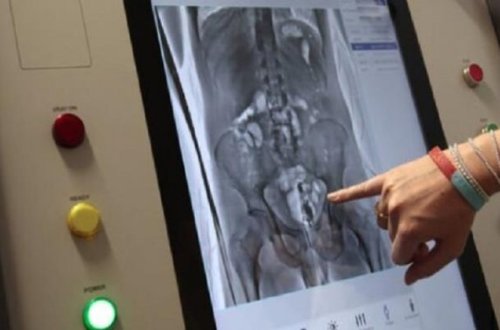 Həbsxanadan çıxan məhkumun anusundan 2 ədəd telefon çıxarıldı...