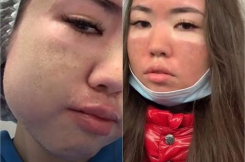 Kosmetoloji prosedurdan sonra qızın üzü dəhşətli hala düşdü - VİDEO