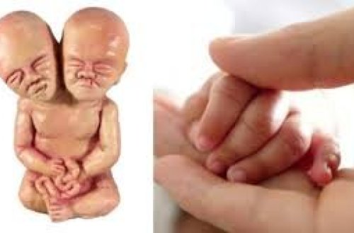 Yeni doğulan bu körpənin bir beyni İKİ BAŞI var - FOTO