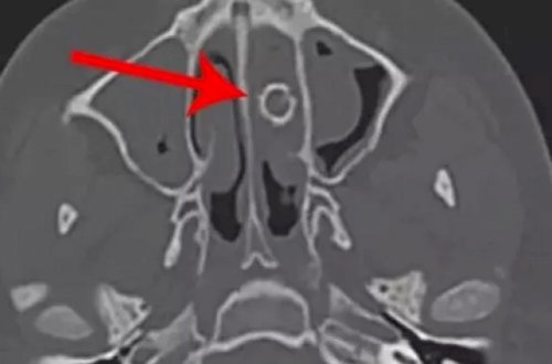 8 ildir burnunda tapança gülləsi gəzdirir