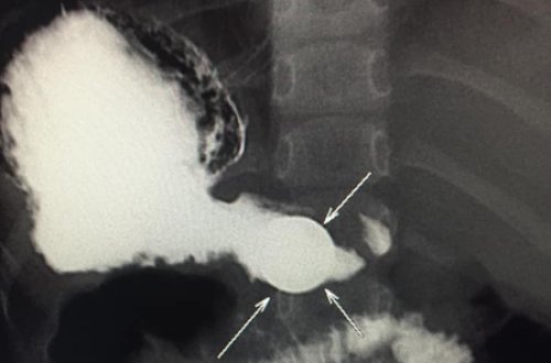 Bakıda 4 yaşlı uşağın mədəsində aşkar edilən metal TƏƏCCÜBLƏNDİRDİ - FOTO