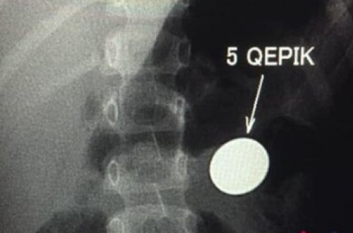 Bakıda 4 yaşlı uşağın mədəsində qəpik AŞKARLANDI