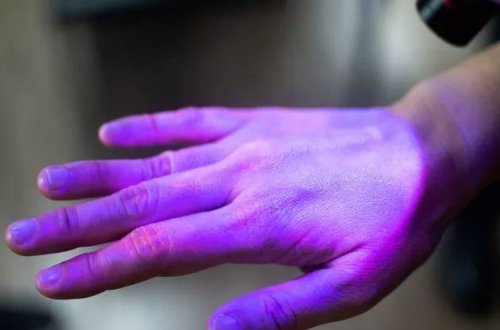 Koronavirusdan sağalanlarda rast gəlinən nadir hadisə