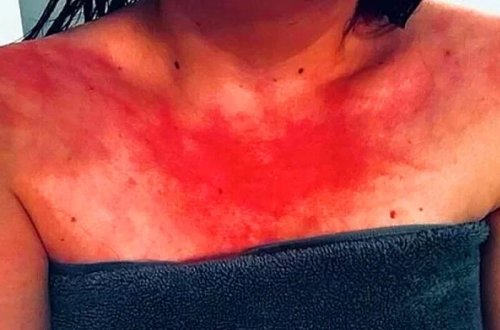 Su allergiyayasının qarşısını almaq mümkündürmü?