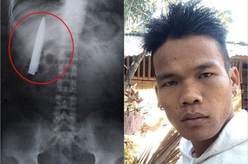 Sinəsinə saplanan bıçaqdan bir il xəbəri olmadı - FOTO