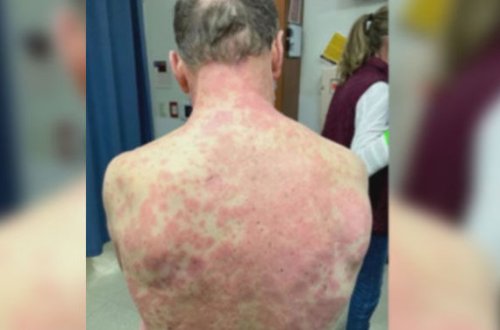 ABŞ istehsalı olan peyvəndin fəsadı - FOTO