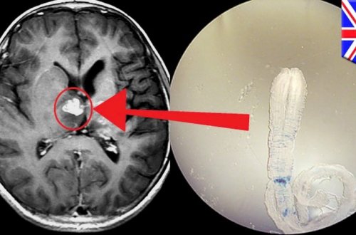 Başınızda bu əlamətlər varsa, deməli beyninizdə qurd var