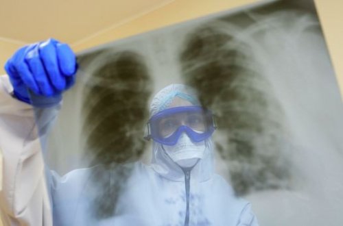 Həkim: “Koronavirus xəstələrinin səhhəti üç günə ağırlaşır” - VİDEO