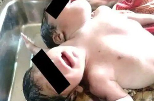 Nadir hadisə - ikibaşlı və üçəlli uşaq doğuldu