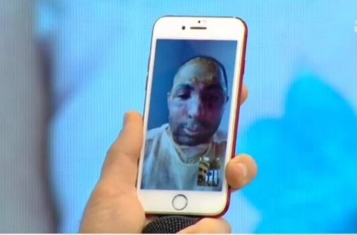 Sevgilisi tərəfindən yandırılan Əlidən ŞOK SÖZLƏR: 