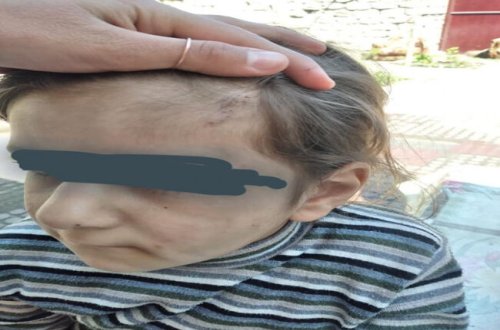 Ailəsi tərəfindən şiddət görən azyaşlı ilə bağlı YENİ XƏBƏR