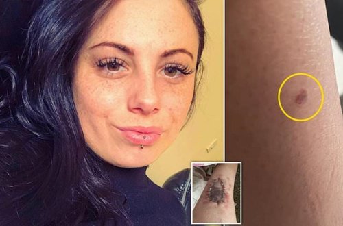 3 ay solariuma getdi, ayağındakı kiçik xal BU HALA DÜŞDÜ - DƏHŞƏTLİ FOTOLAR