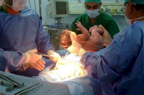 Bakıda əkizlər doğuş zamanı öldü