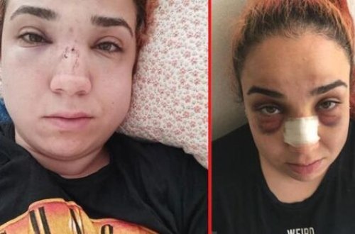 Müdir işdə telefonla danışan Zeynəbi süpürgəylə DÖYÜB BU HALA SALDI - FOTO