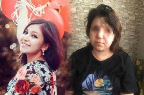 Gəncə terrorunda 2 gözünü itirən Pərvin... - FOTO