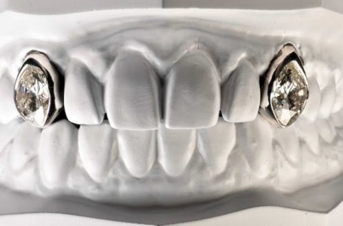 Tanınmış reper dişlərinə 2 milyonluq brilyant qoydurdu - FOTO