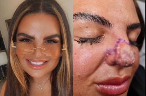 Daha gözəl görünmək istəyən qadın burnunu və dodağını itirmə təhlükəsi ilə üzləşdi - FOTO