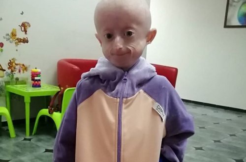 10 yaşlı qız qocalıqdan öldü - VİDEO