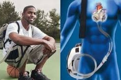 Kürəyində süni ürəklə 555 gün yaşadı - FOTO-VİDEO