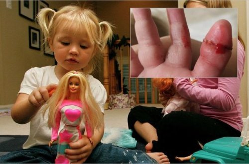 Balaca uşaq gəlinciyin saçına görə barmağını itirəcəkdi - FOTO