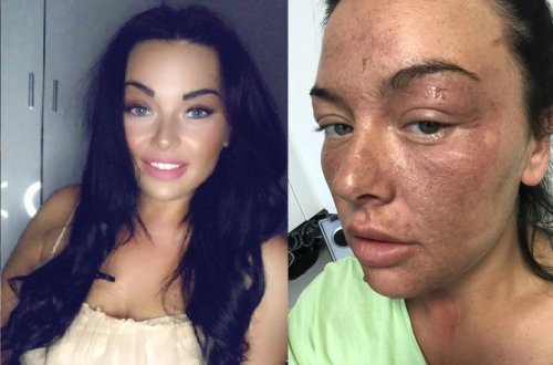 “TikTok”dakı üsulla yumurta bişirməyə çalışan qadının bütün üzü yandı - VİDEO