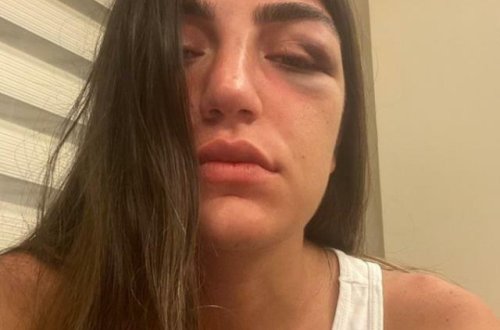 Gecə klubuna gedən modeli sevgilisi döydü, burnunu qırdı - VİDEO - FOTO