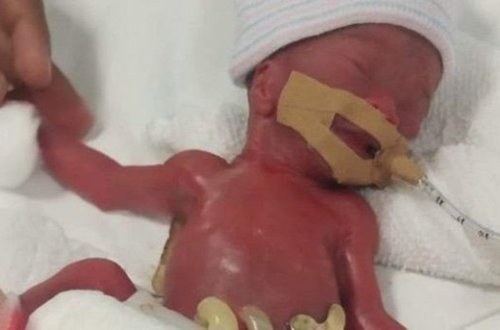 Sinqapurda dünyanın ən balaca uşağının həyatı xilas edilib