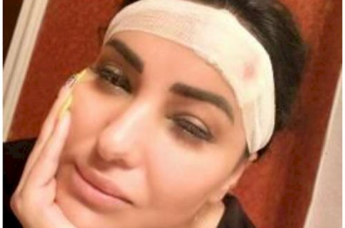 Vüsalənin başına iş gəldi: Alnına tikiş qoyuldu