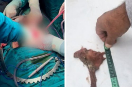 Azərbaycanda növbəti həkim səhvi: 8 ay əvvəl... -FOTO -VİDEO