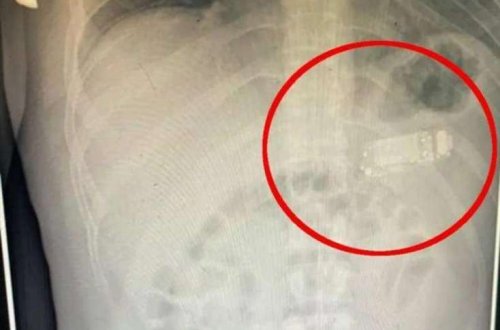 Həkimlər 33 yaşlı şəxsi rentgen aparatına saldılar: ŞOK OLDULAR - FOTOLAR