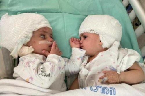 İsraildə siam əkizlərinin ayrılması üzrə uğurlu əməliyyat keçirilib – VİDEO